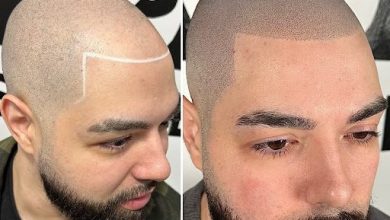 micro-scalp-pigmentation-nyc:-the-latest-trends-and-innovations-in-hair-restoration